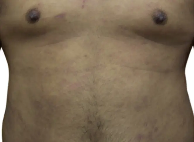 After 3 months eczema on lower chest and abdomen