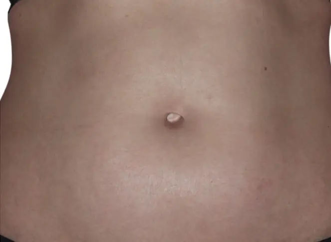 after 2 weeks eczema on abdomen