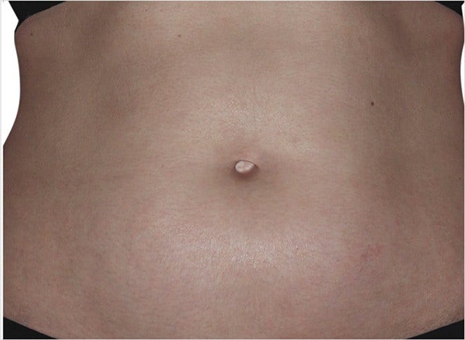 after 2 weeks eczema on abdomen