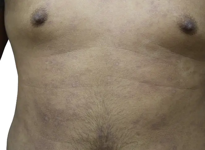 after 2 weeks eczema on lower chest and abdomen