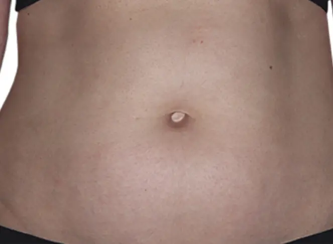 after 3 months eczema on abdomen