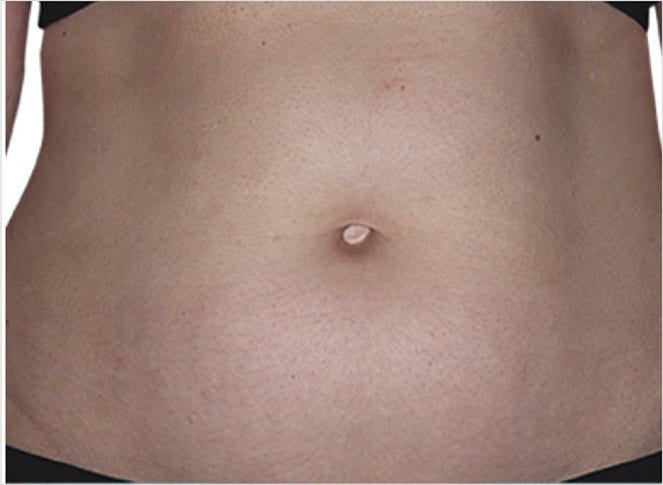 after 3 months eczema on abdomen