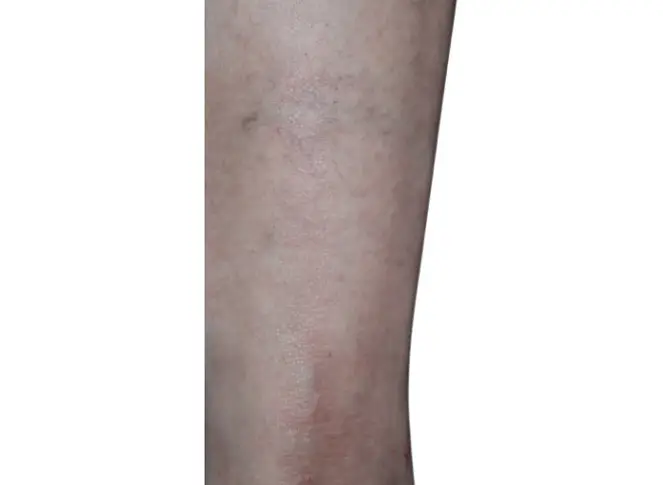 after 3 months eczema on lower shin