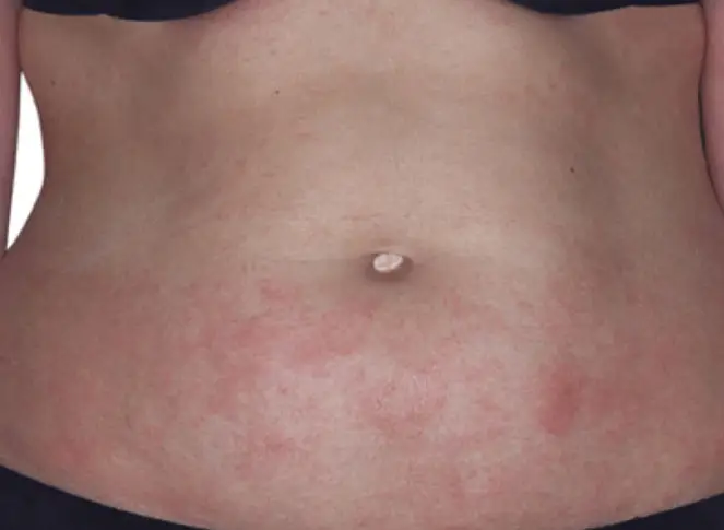 before eczema on abdomen
