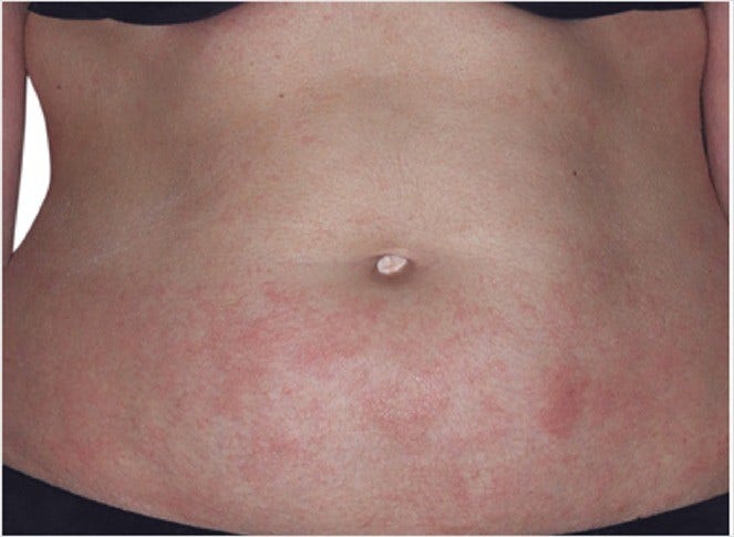 Before eczema on abdomen