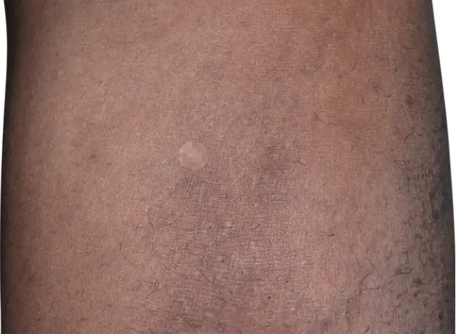 after 3 months eczema on calf