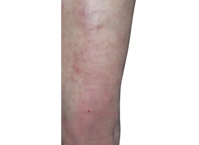 before eczema on lower shin