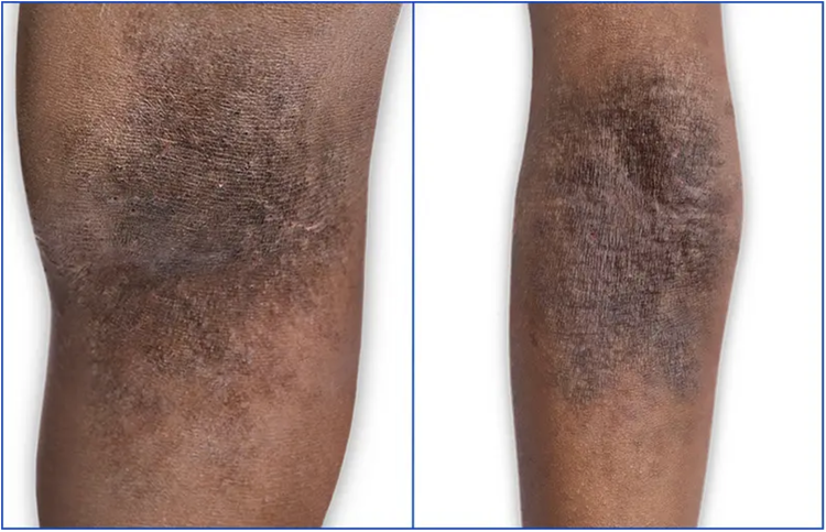 darker skin tones eczema zoom in