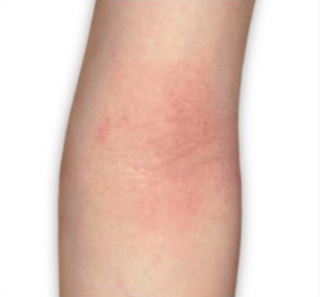 taking CIBINQO™ (abrocitinib) comparison