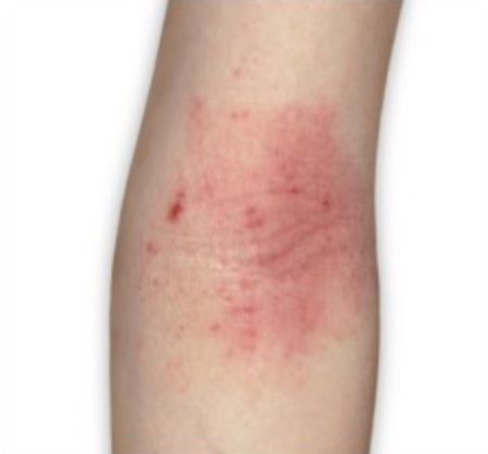 taking CIBINQO™ (abrocitinib) comparison