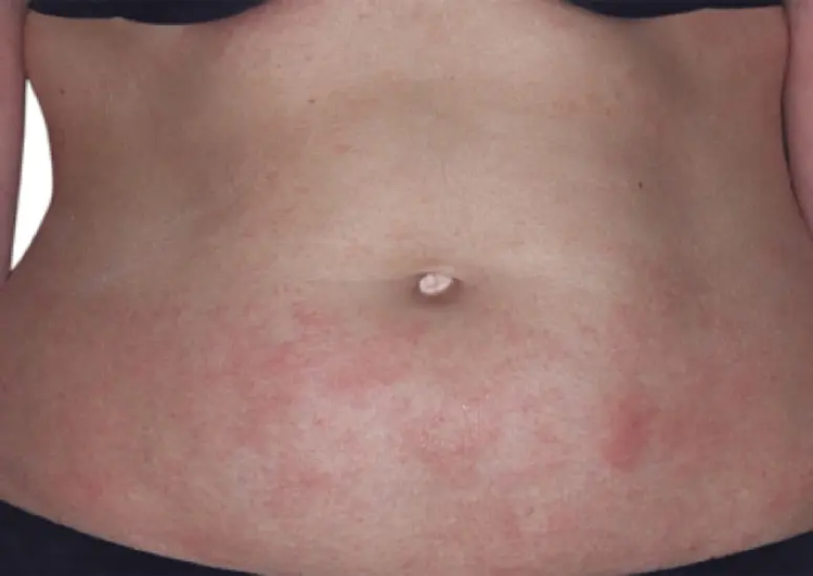 Before Eczema on Abdomen