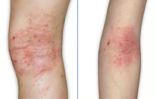About eczema lighter skin tones