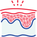 What causes eczema inflammation